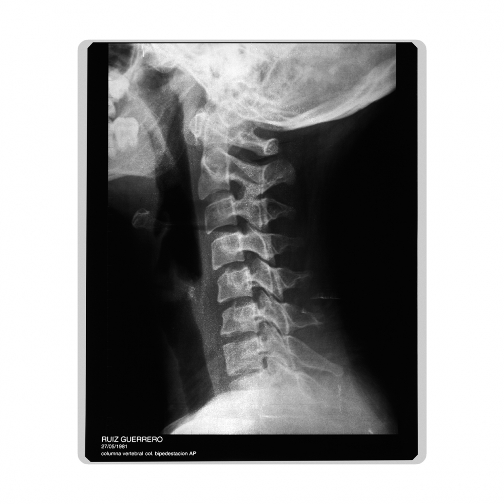 Imagen en la que se ve una radiografía